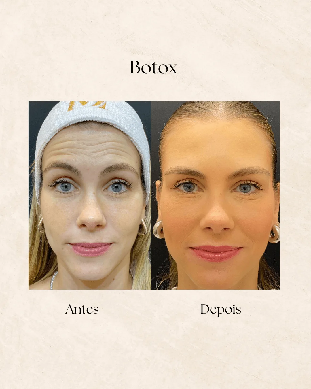 Antes e depois de aplicação de toxina botulínica