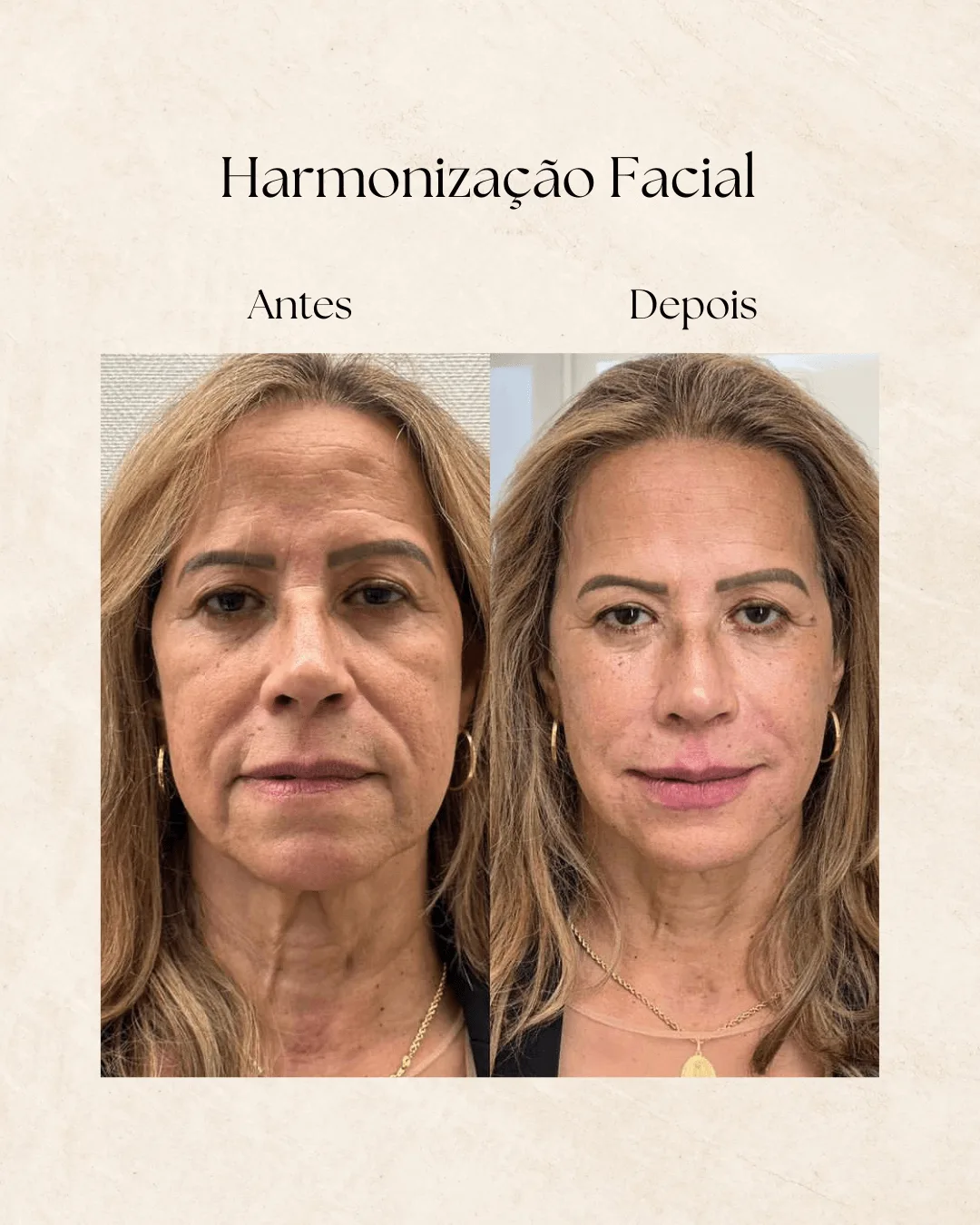 Antes e depois de harmonização facial