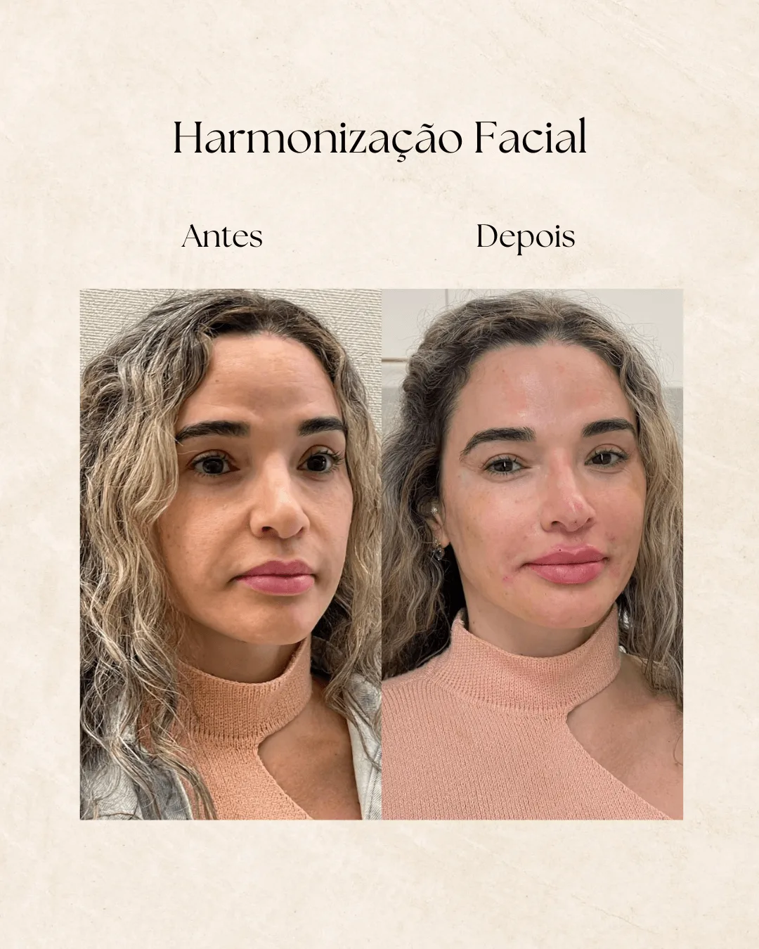 Antes e depois de harmonização facial