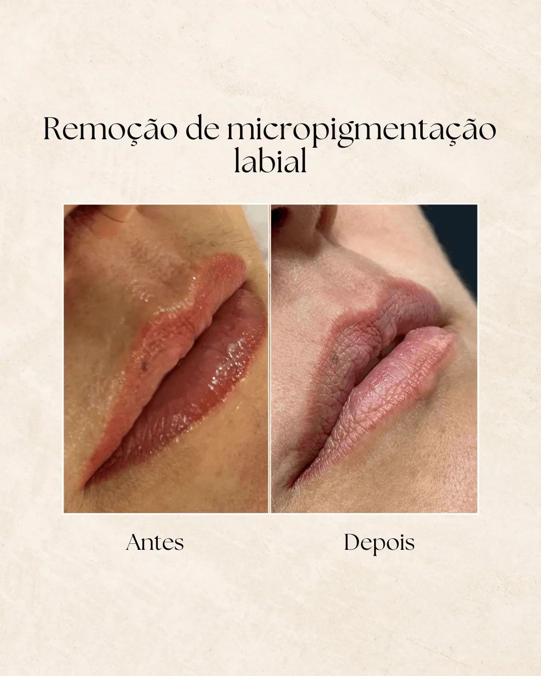 Antes e depois de remoção de tatuagem