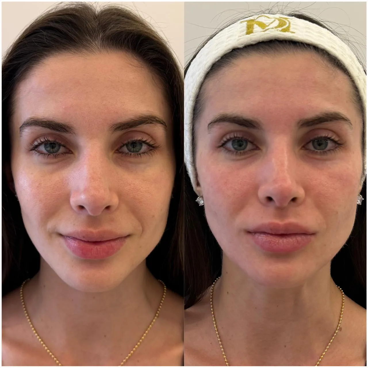 Resultado de rejuvenescimento facial com laser Fotona na Clínica Dermique